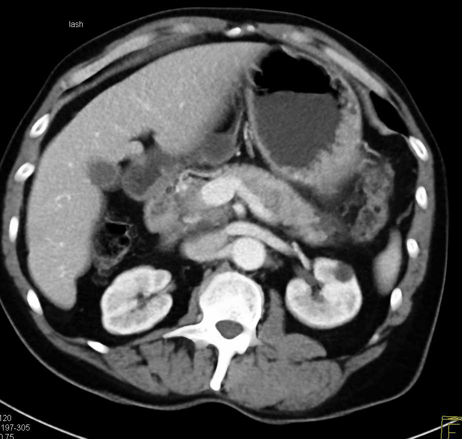 Autoimmune Pancreatitis - CTisus CT Scan