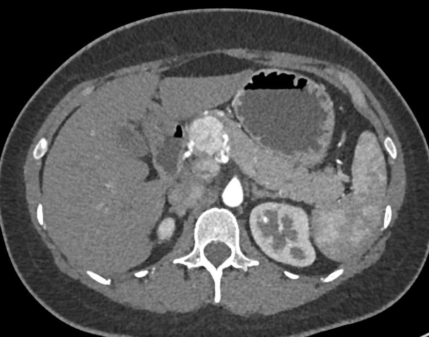 Neuroendocrine Tumor of the Head of the Pancreas Seen Best on Arterial Phase - CTisus CT Scan