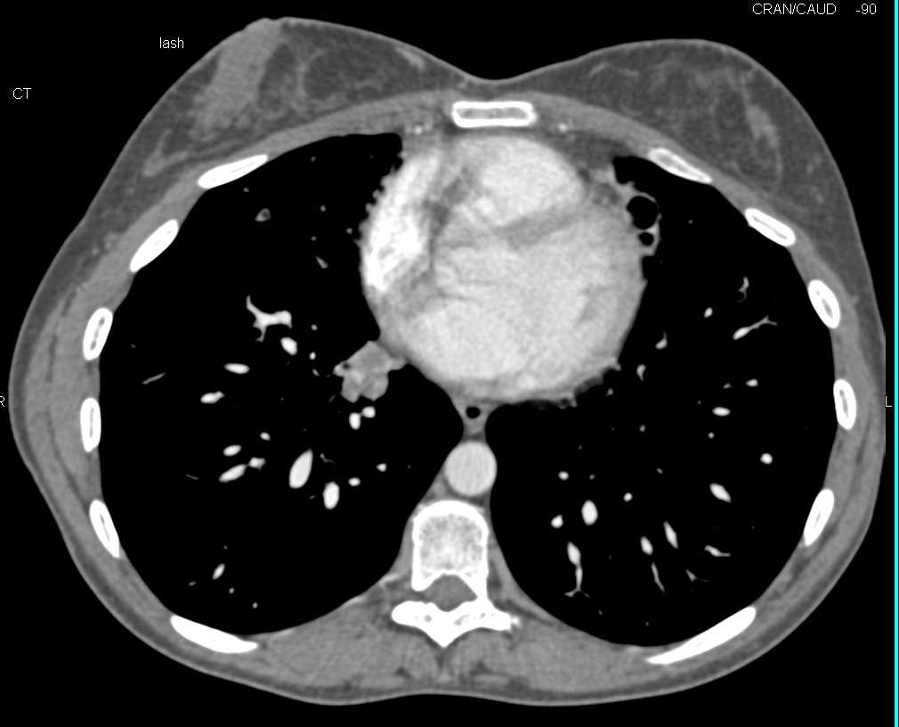 Cystic Lesion in Head of Pancreas in Cystic Fibrosis - CTisus CT Scan