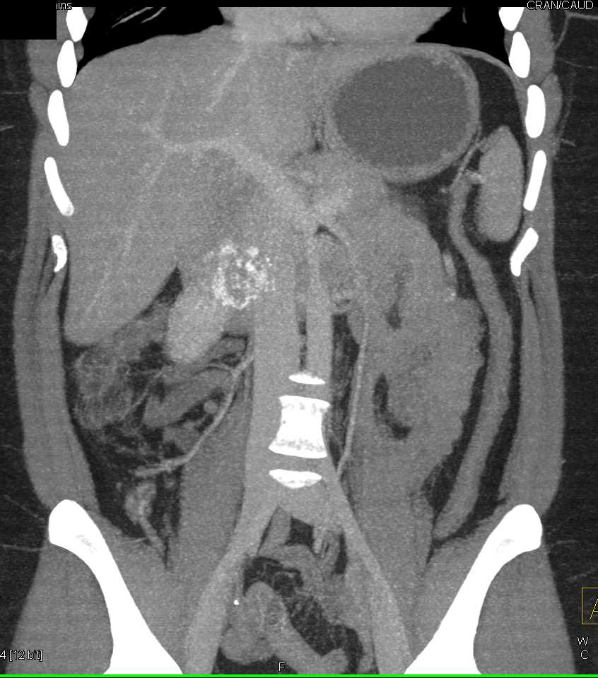 SPEN (Solid and Papillary Epithelial Neoplasm) - CTisus CT Scan