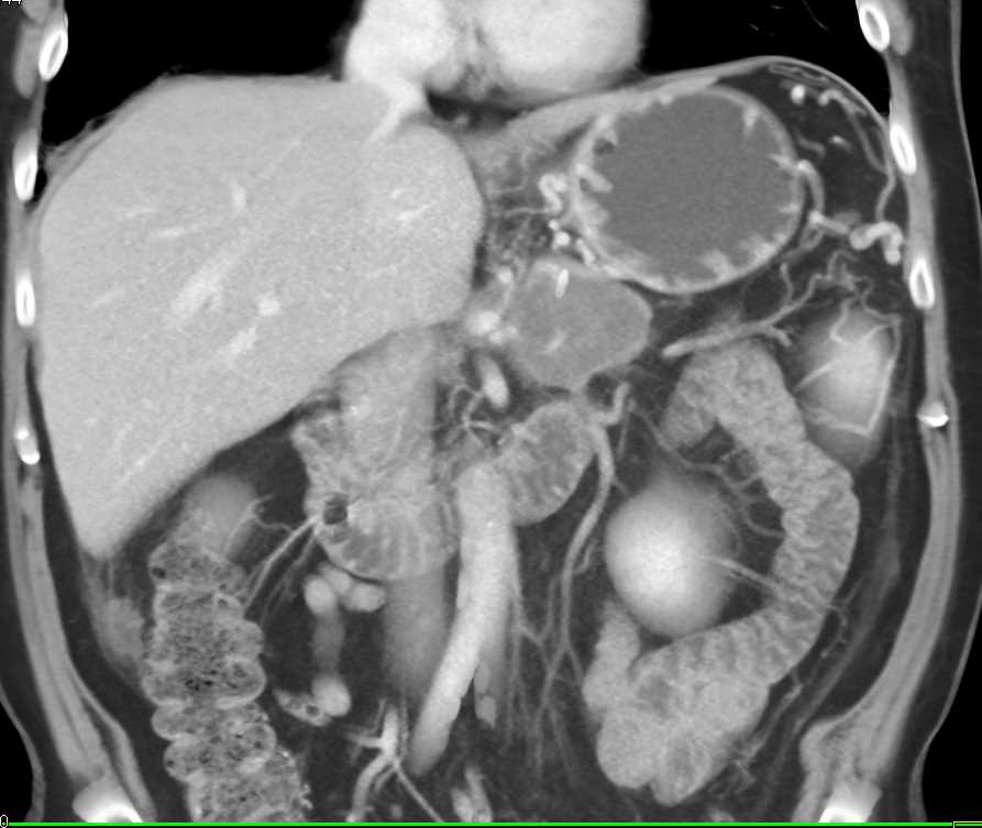 Pancreatic Cancer with Carcinomatosis - CTisus CT Scan