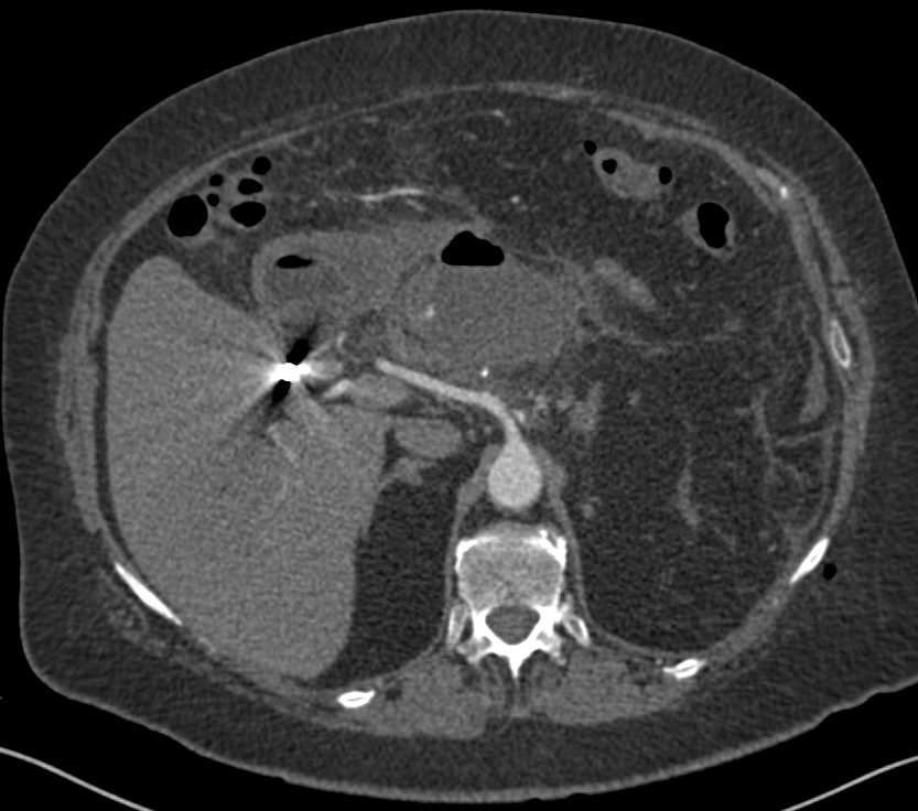 Abscess in the Pancreatic Bed - CTisus CT Scan