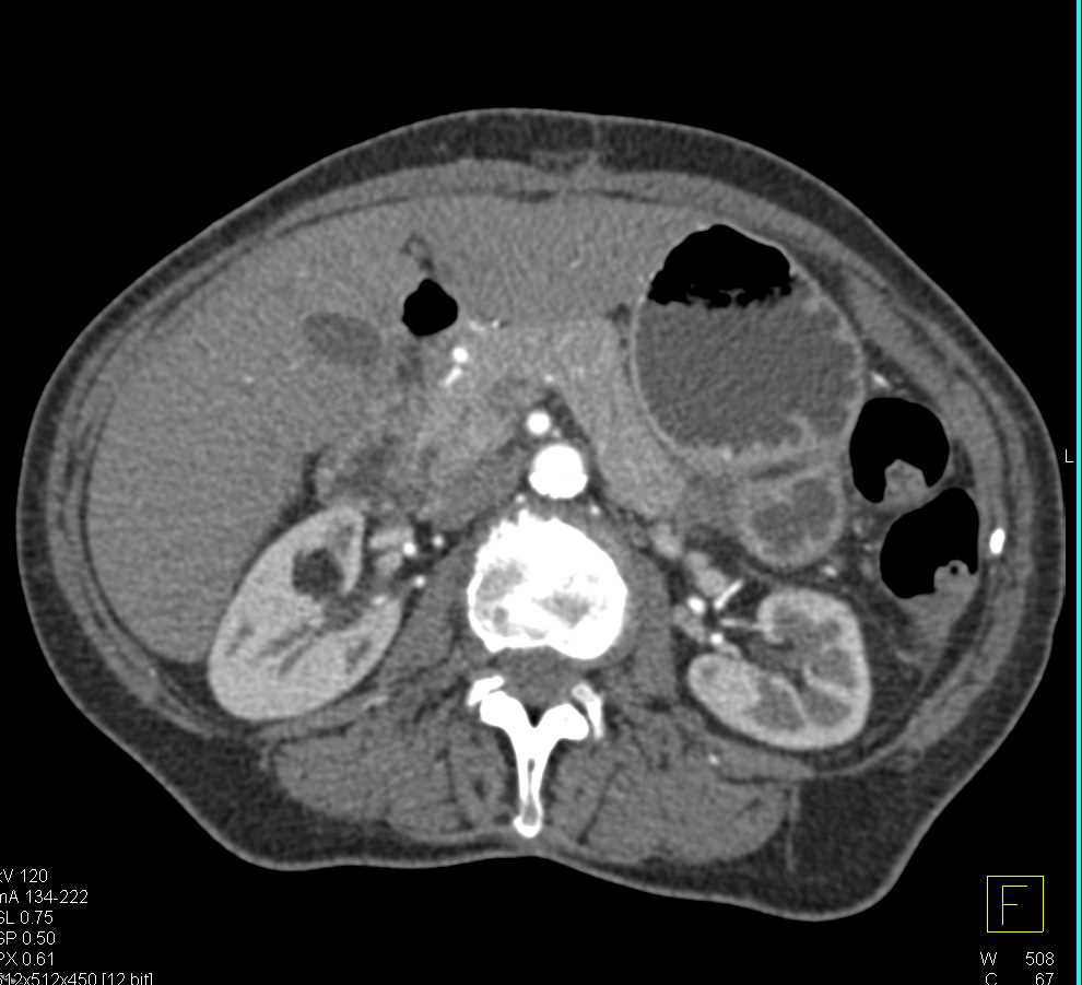 SPEN (Solid and Papillary Epithelial Neoplasm) in the Tail of the Pancreas - CTisus CT Scan