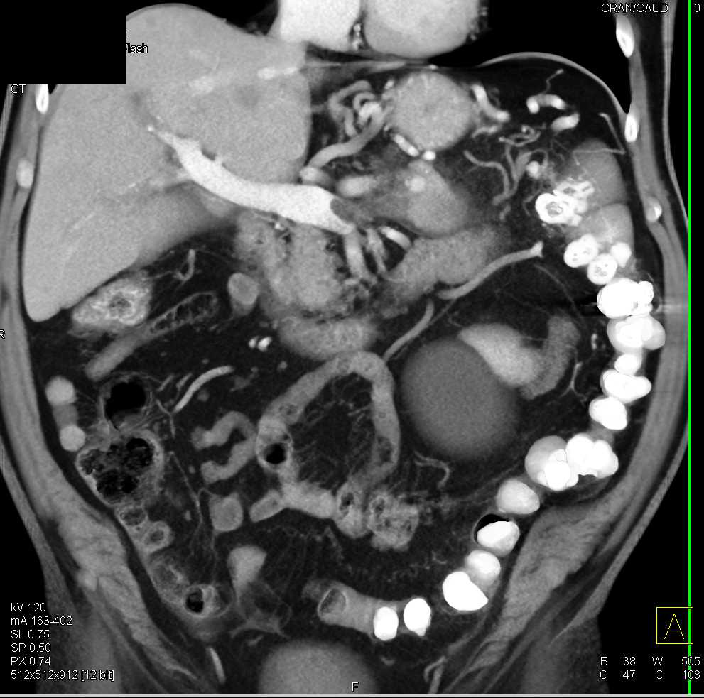 Pancreatic Cancer Invades the Splenic Vein and Portal Vein - CTisus CT Scan