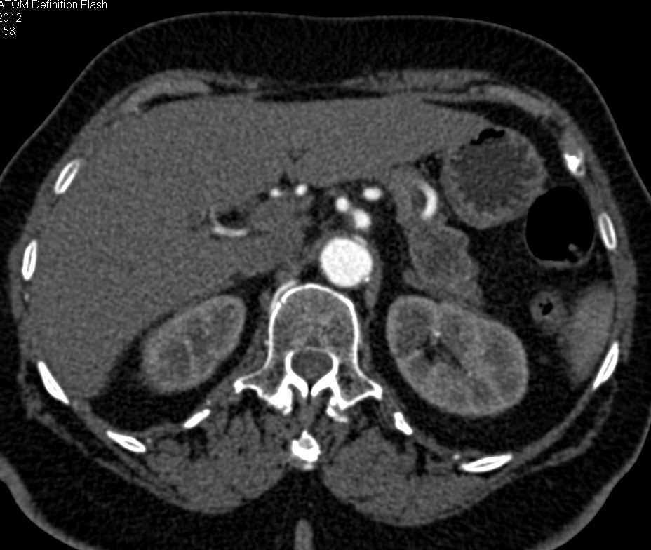 Adenocarcinoma of the Tail of the Pancreas - CTisus CT Scan