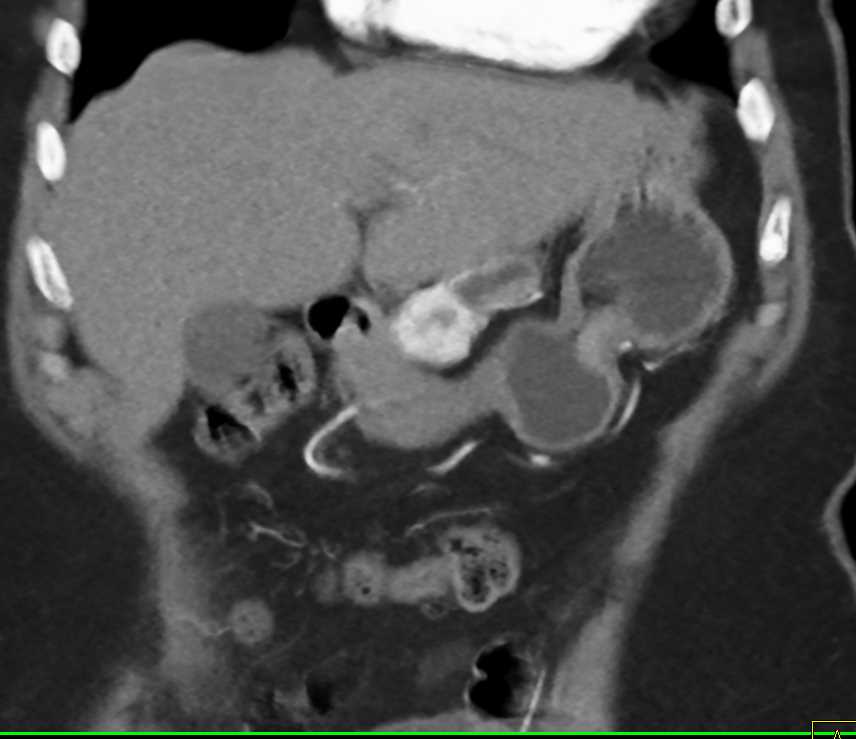 Neuroendocrine Tumor of the Pancreas - CTisus CT Scan