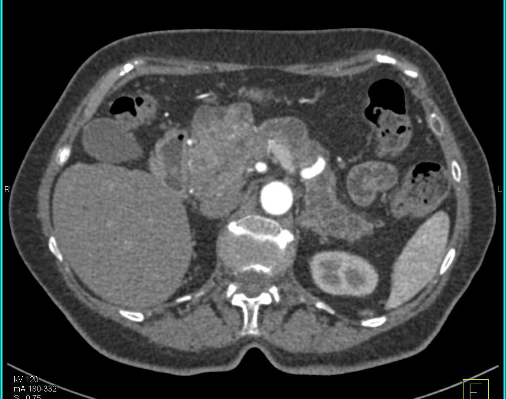 Multiple Intraductal Papillary Mucinous Neoplasms (IPMNs) with Pancreatic Cancer - CTisus CT Scan