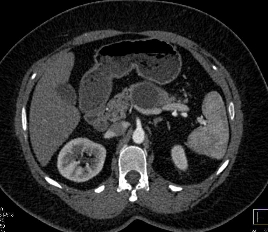 MCN-Mucinous Cystic Neoplasm of the Pancreas - CTisus CT Scan