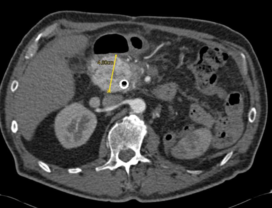 Recurrent Renal Cell Carcinoma Involves the Head of the Pancreas and the Right Adrenal Gland - CTisus CT Scan