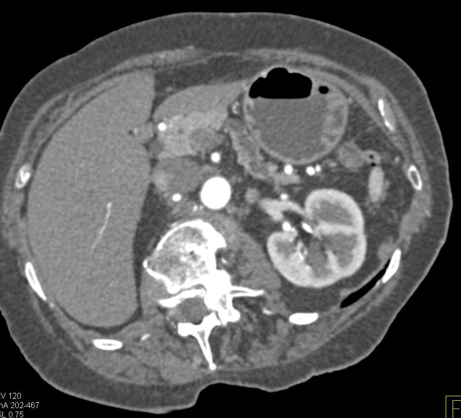 Subtle Carcinoma of the Body of the Pancreas with Dilated Pancreatic Duct - CTisus CT Scan