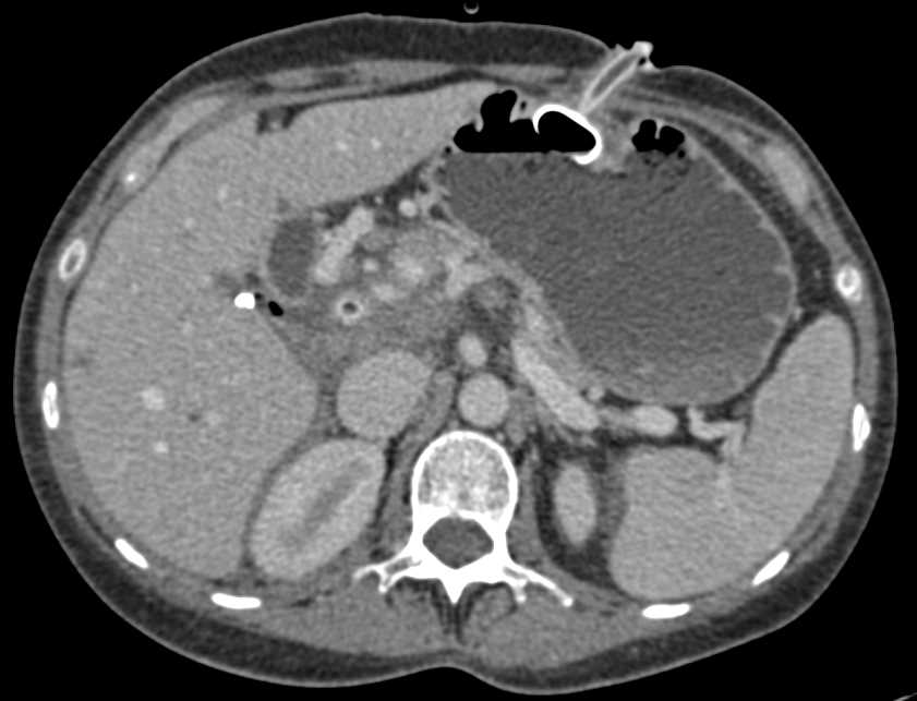 Pancreatic Cancer with Carcinomatosis - CTisus CT Scan