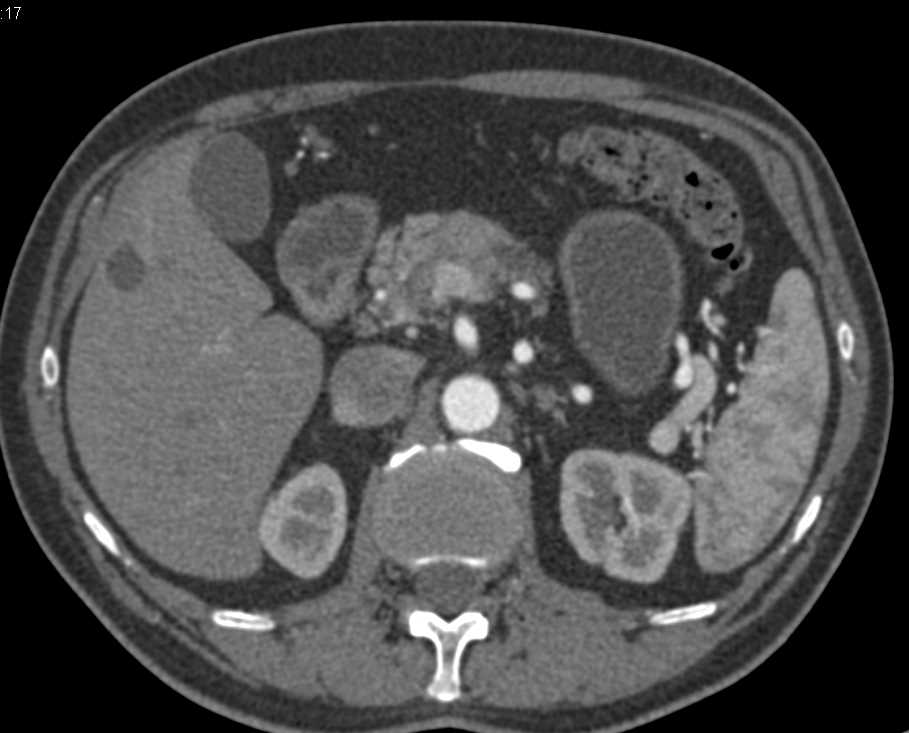 Carcinoma of the Body of the Pancreas - CTisus CT Scan