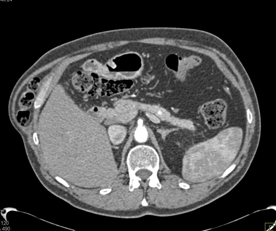 5mm Neuroendocrine Tumor in the Body of the Pancreas - CTisus CT Scan