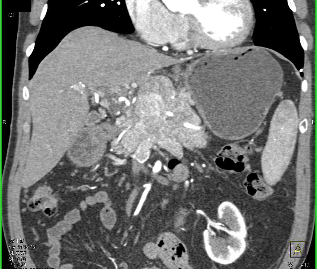 Neuroendocrine Tumor of the Pancreas is Hypervascular and Invades the Portal Vein - CTisus CT Scan