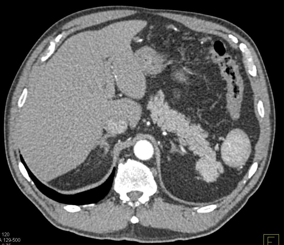 Splenules Positioned Near the Tail of the Pancreas - CTisus CT Scan