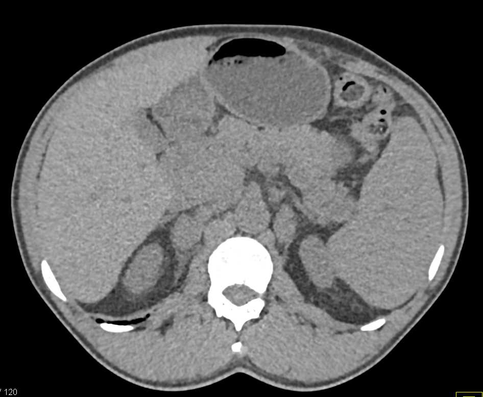 Lymphoma Infiltrates the Head of the Pancreas and Adrenal Glands and Spleen - CTisus CT Scan