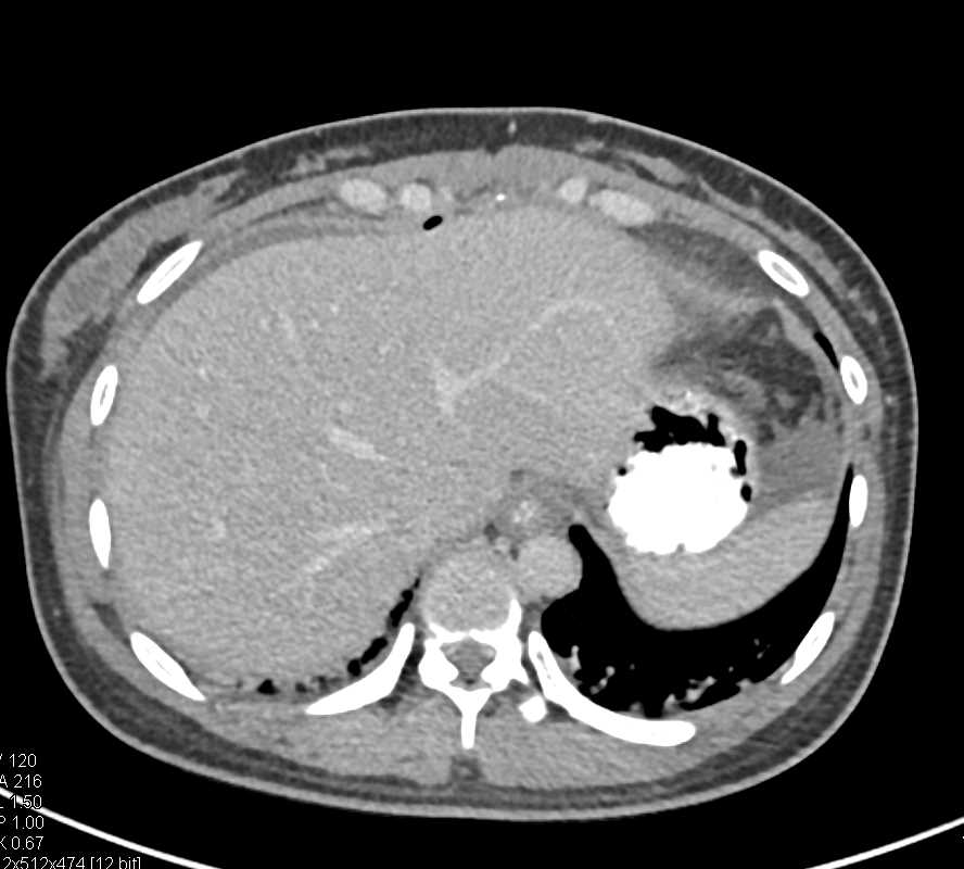 Pancreatic Tumor with Extension to the Tail of the Pancreas - CTisus CT Scan