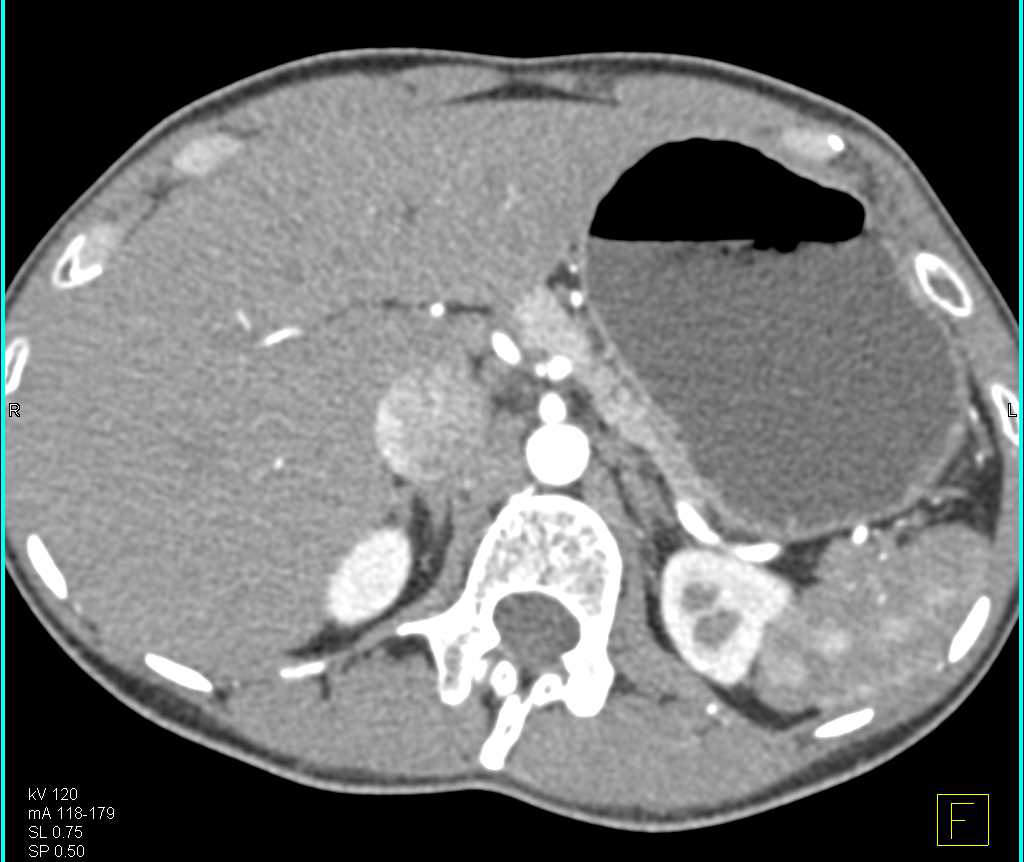 1 cm Neuroendocrine Tumor in Body of Pancreas Seen Only on Arterial Phase Imaging - CTisus CT Scan