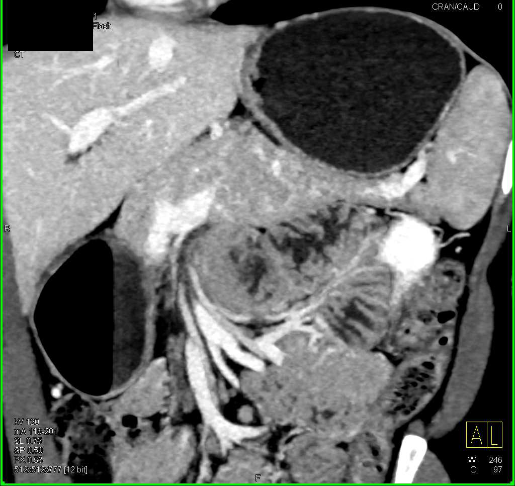 1 cm Neuroendocrine Tumor in Body of Pancreas Seen Only on Arterial Phase Imaging - CTisus CT Scan