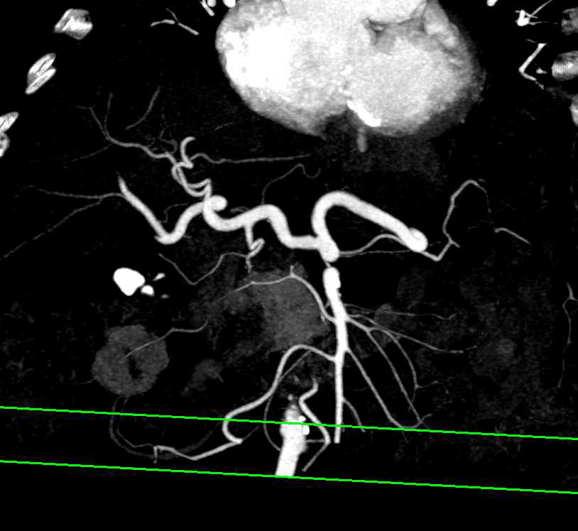 Pancreatic Cancer Obstructs the Pancreatic Duct with Superior Mesenteric Artery (SMA) and Portal Vein (PV) Involvement - CTisus CT Scan