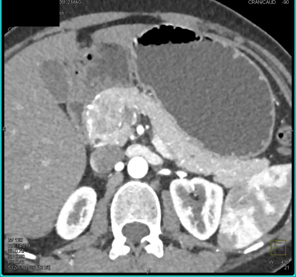 Unusual Serous Cystadenoma in the Head of the Pancreas - CTisus CT Scan