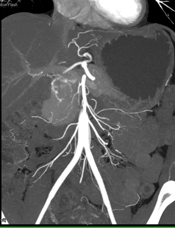 Unusual Serous Cystadenoma in the Head of the Pancreas - CTisus CT Scan