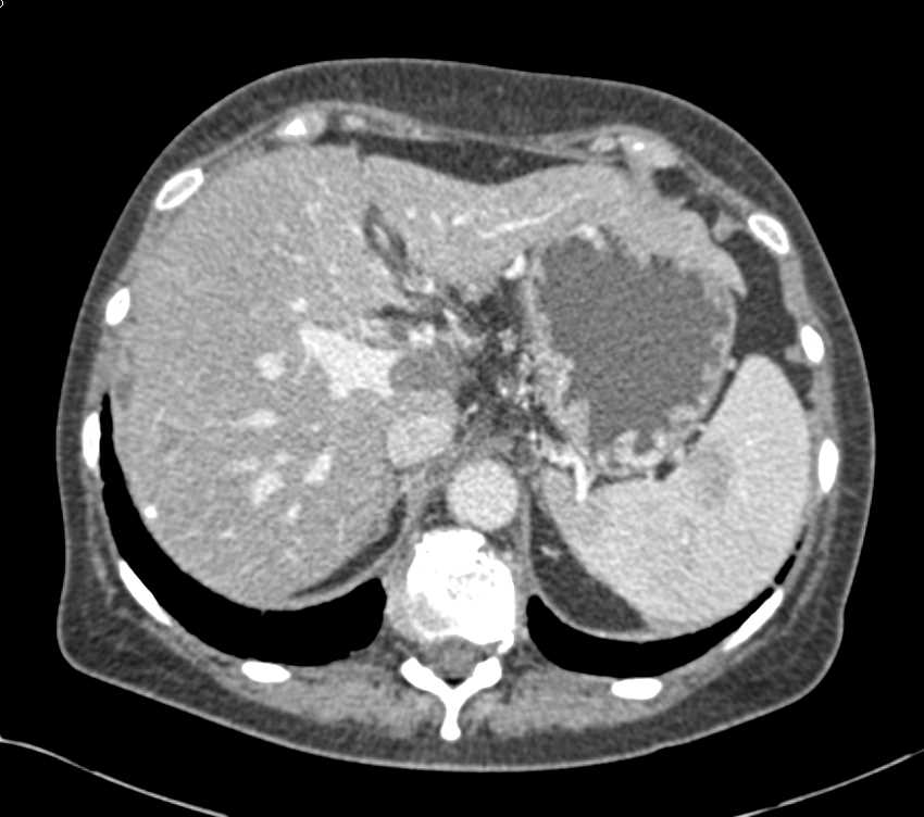 Neuroendocrine Tumor of the Pancreas is Hypovascular and Invades the Portal Vein - CTisus CT Scan