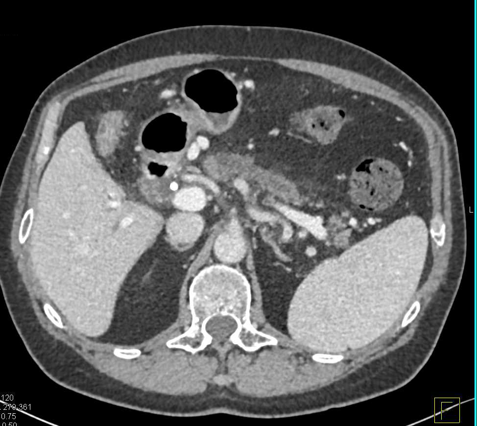 Subtle Pancreatic Cancer with Obstruction of Pancreatic Duct - CTisus CT Scan