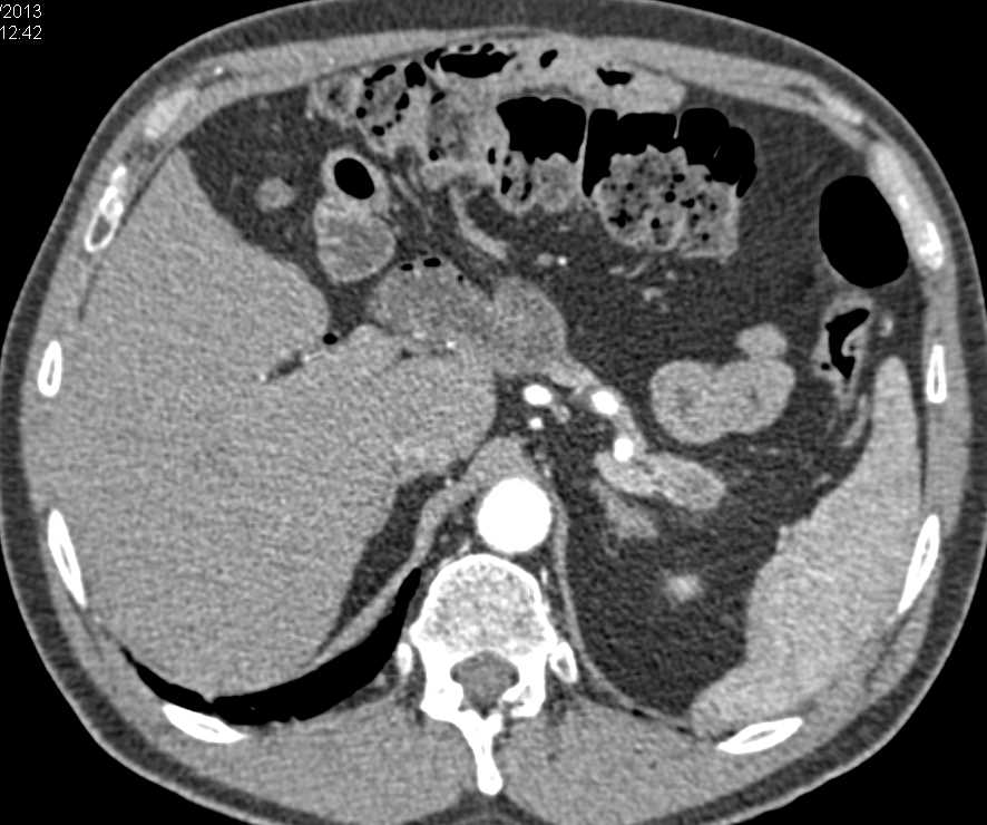 Subtle Carcinoma Tail of Pancreas - CTisus CT Scan