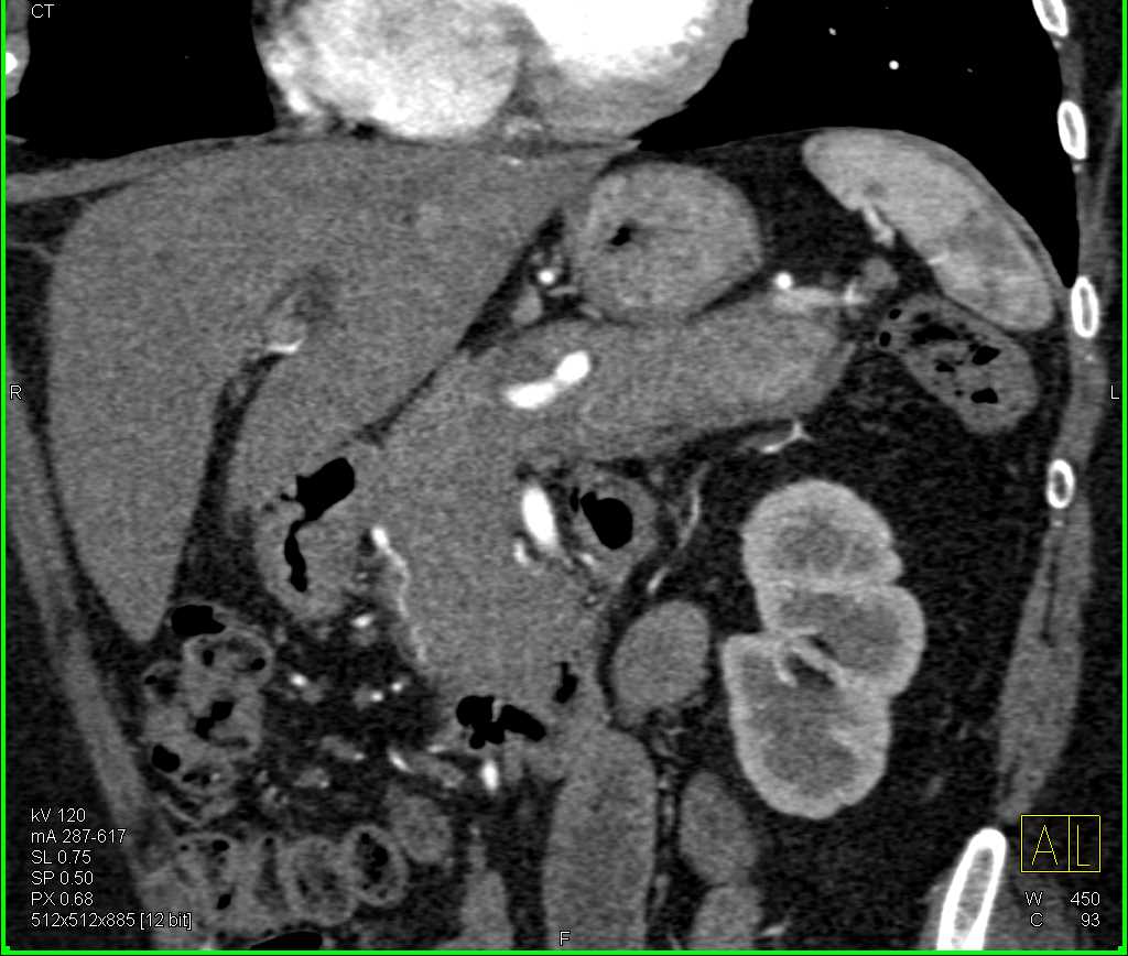 Autoimmune Pancreatitis - CTisus CT Scan