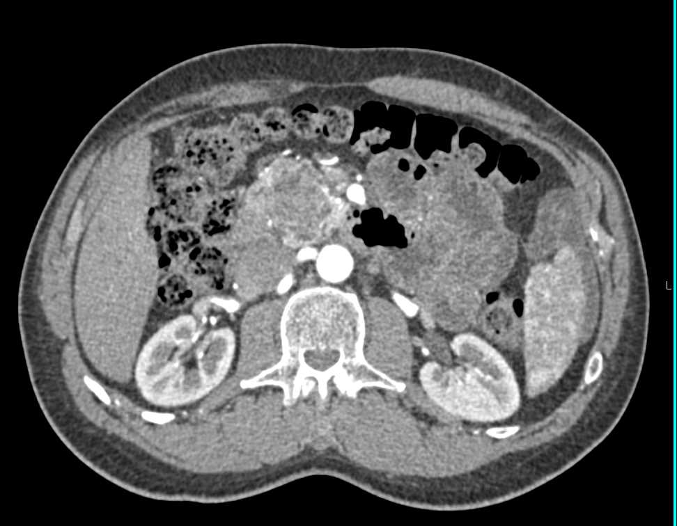 Atypical Appearance to Serous Cystadenoma - CTisus CT Scan