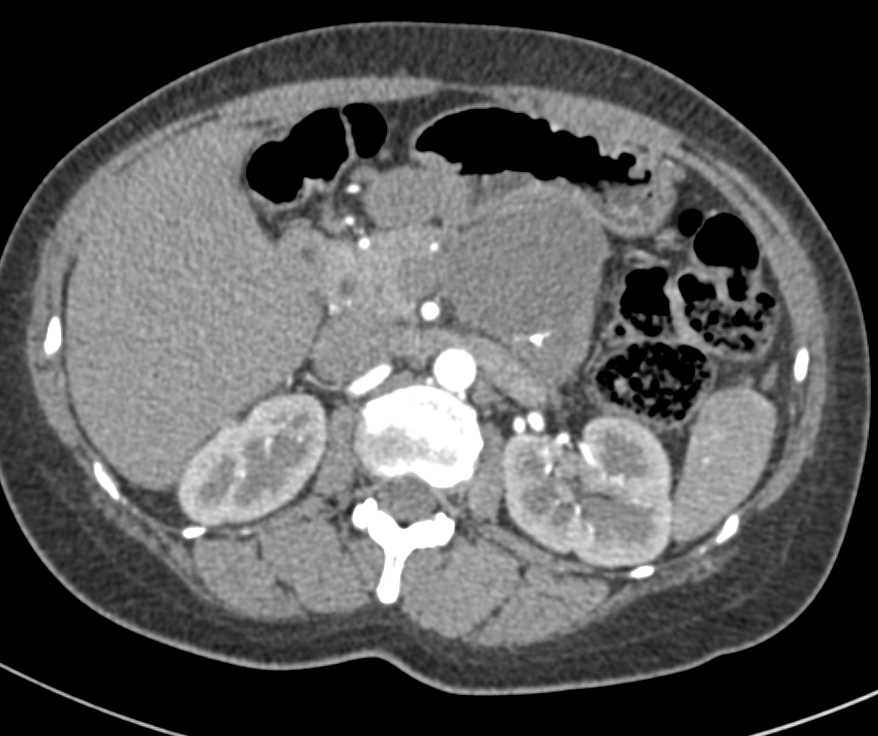 Pseudocyst at the Site of a Distal Pancreatectomy and Splenectomy - CTisus CT Scan