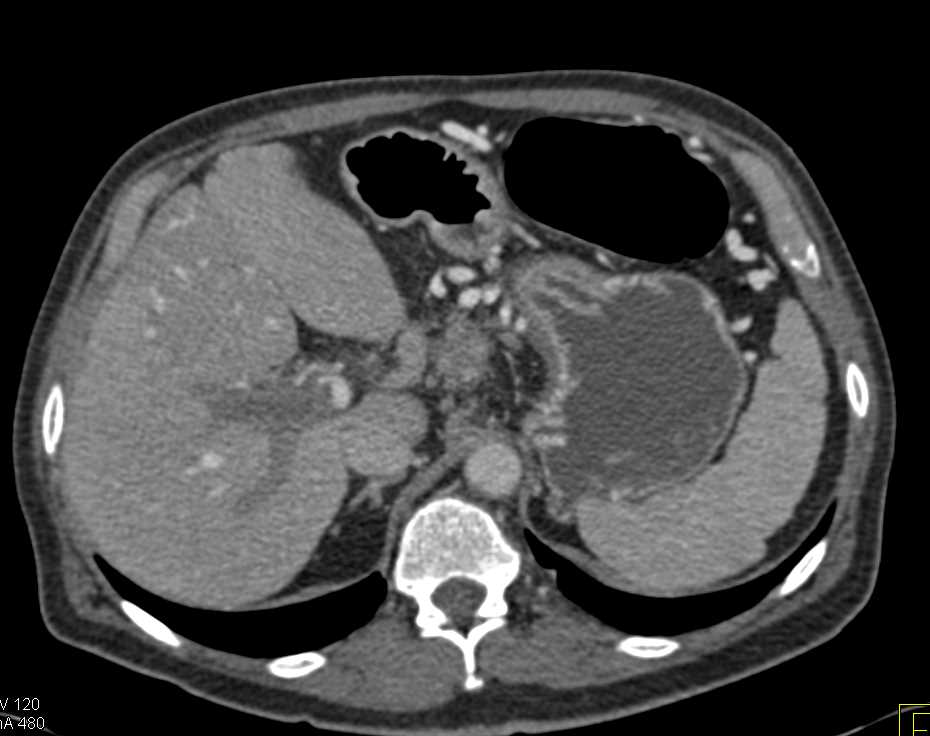 Invasive Neuroendocrine Pancreatic Tumor with Vessel Invasion - CTisus CT Scan