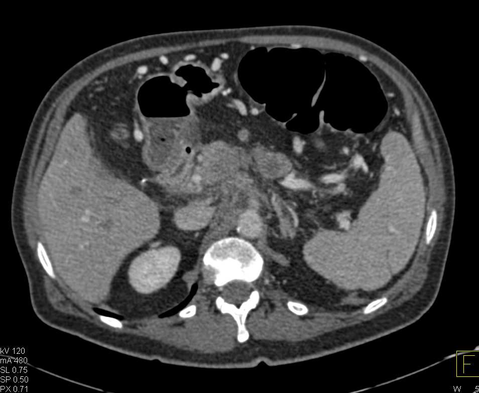 Pancreatic Tumor with Extension into the Portal Vein and Superior Mesenteric Vein (SMV) - CTisus CT Scan