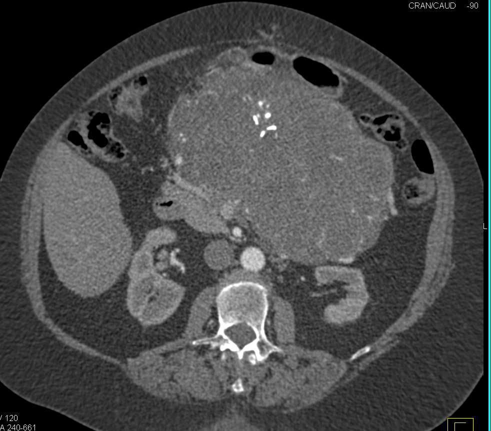 Serous Cystadenoma - CTisus CT Scan