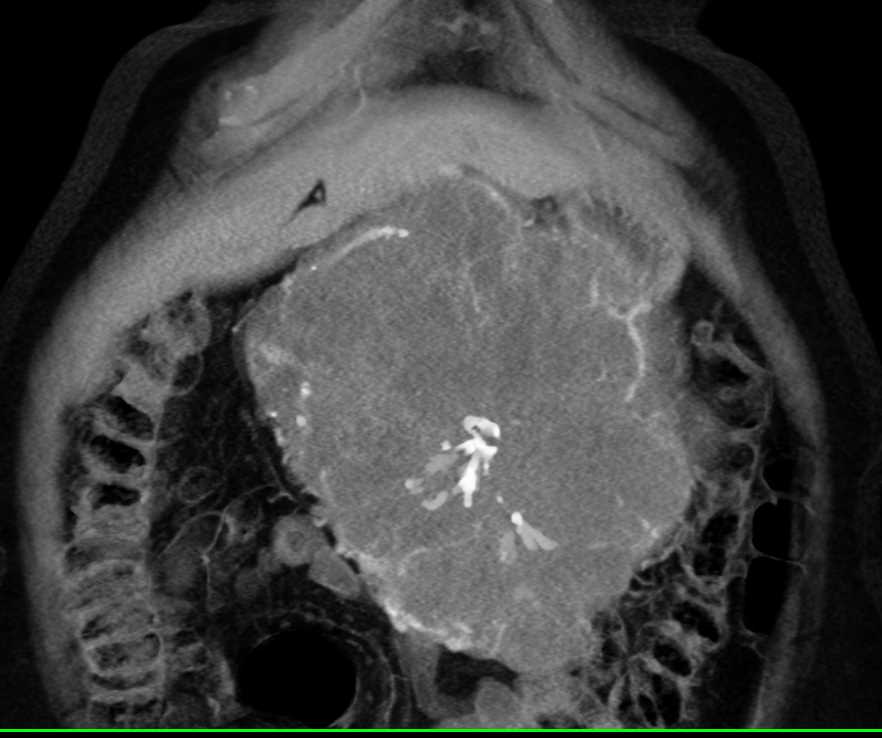 Serous Cystadenoma - CTisus CT Scan