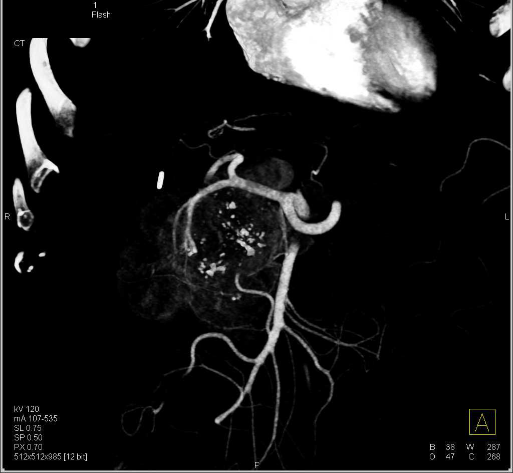 Neuroendocrine Tumor in the Head of the Pancreas - CTisus CT Scan