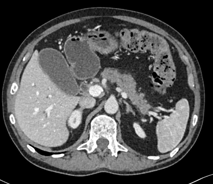 Subtle Mass in the Head of the Pancreas - CTisus CT Scan