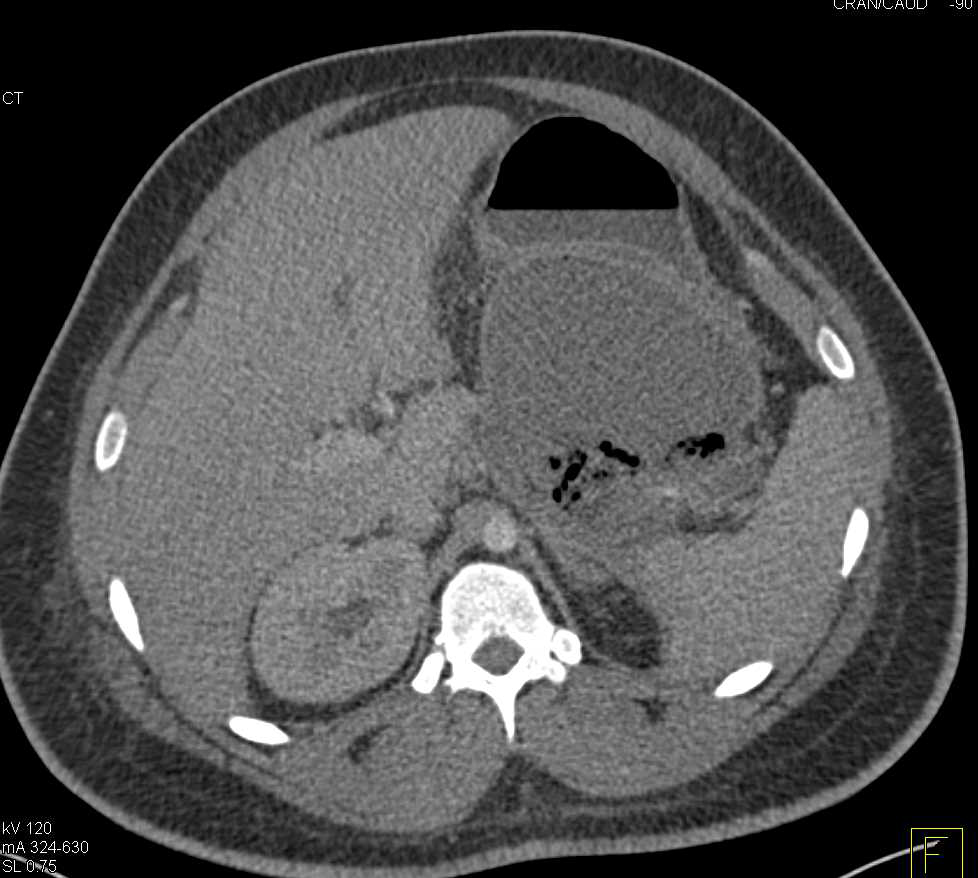 Infected Pancreatic Pseudocyst - CTisus CT Scan