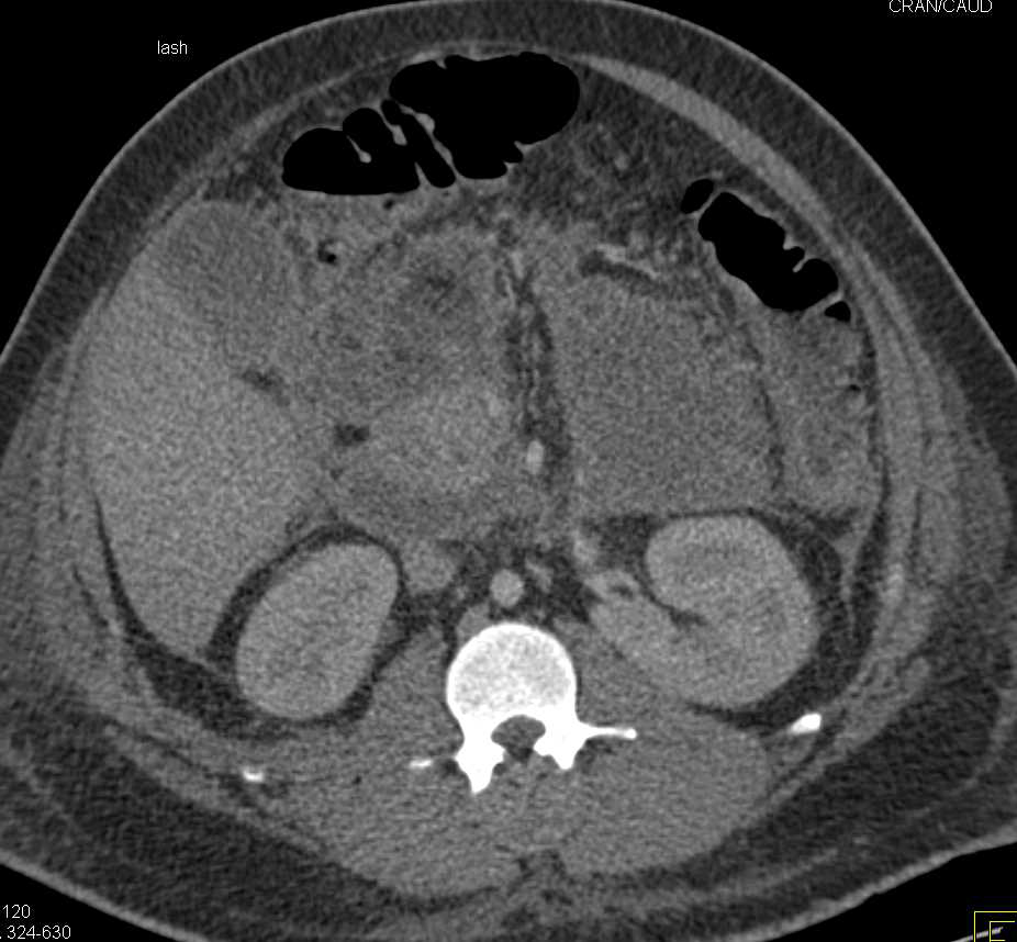 Pancreatic Necrosis - CTisus CT Scan