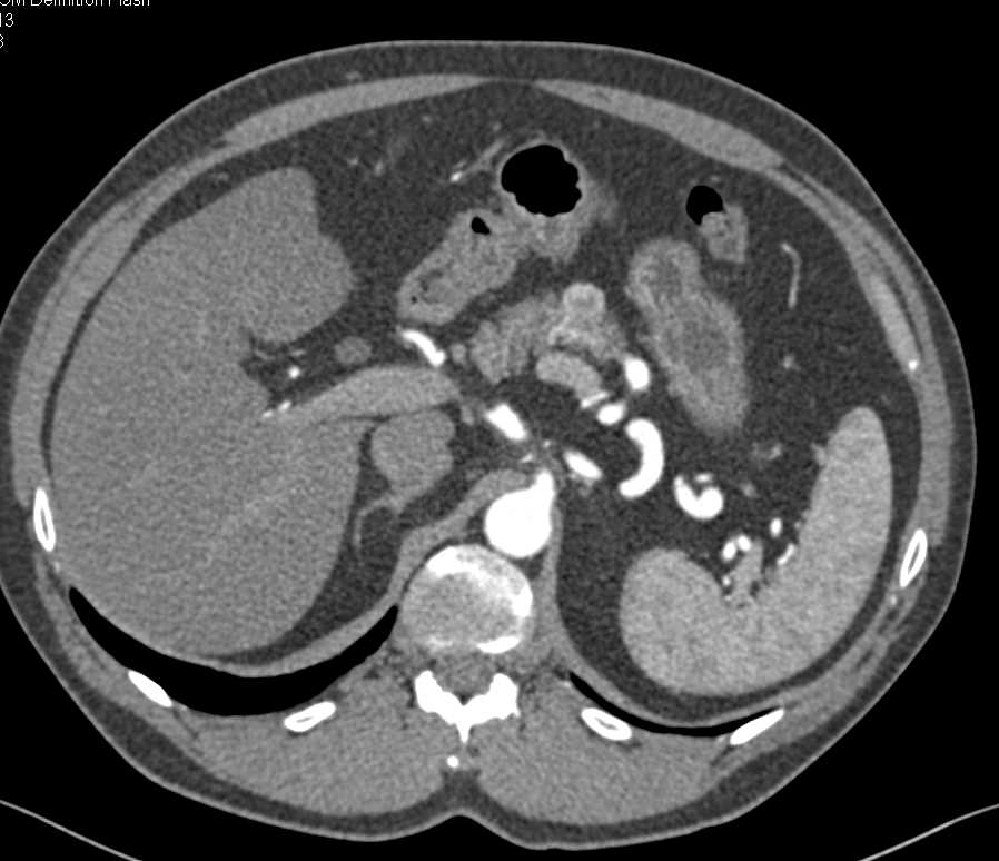 1 cm Neuroendocrine Tumor Arising off the Body of the Pancreas - CTisus CT Scan