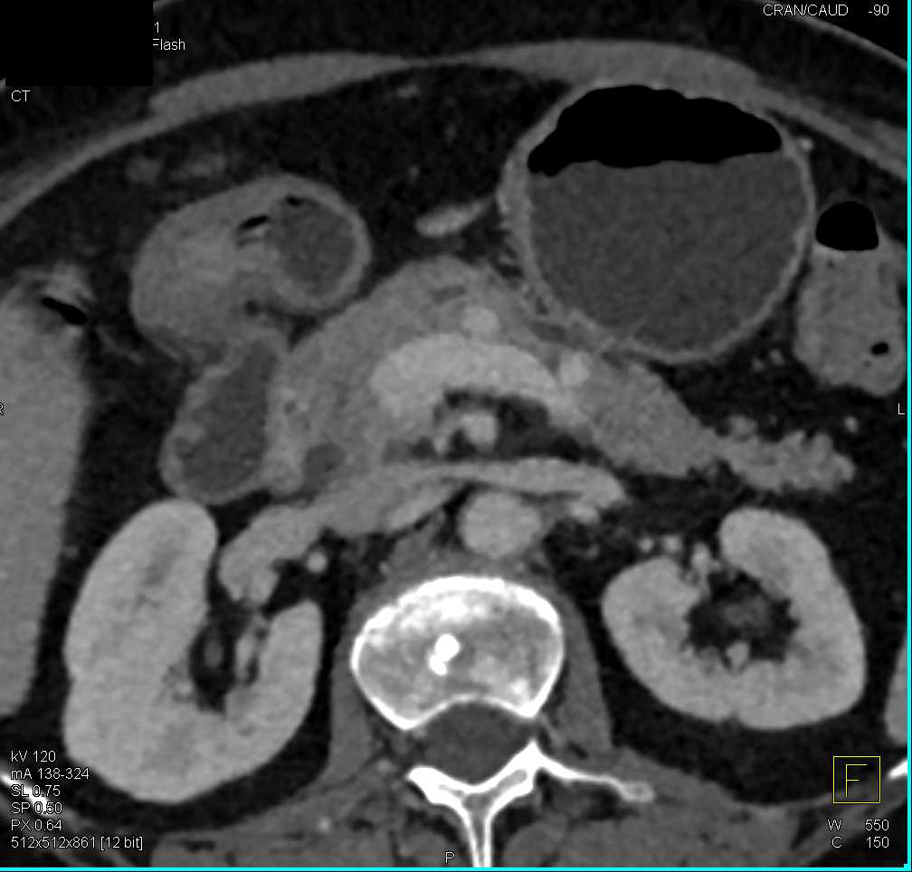 Neuroendocrine Tumor in the Body of the Pancreas - CTisus CT Scan