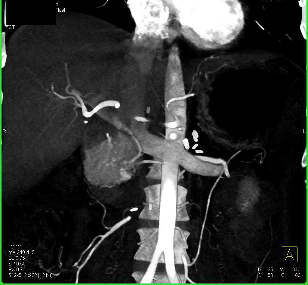 Subtle Neuroendocrine Tumor Head of the Pancreas - CTisus CT Scan