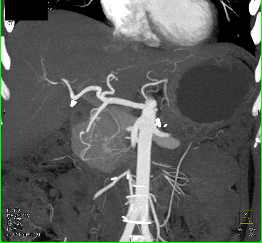 Subtle Neuroendocrine Tumor Head of the Pancreas - CTisus CT Scan