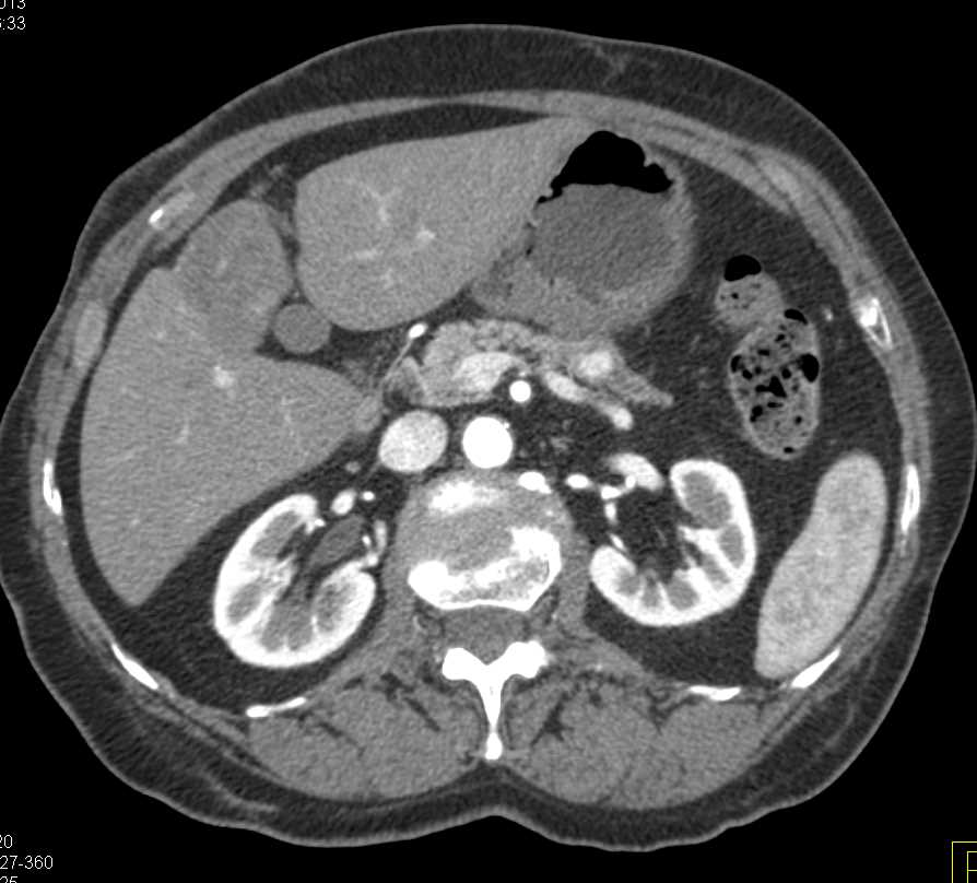 1cm Neuroendocrine Tumor Body of the Pancreas - CTisus CT Scan