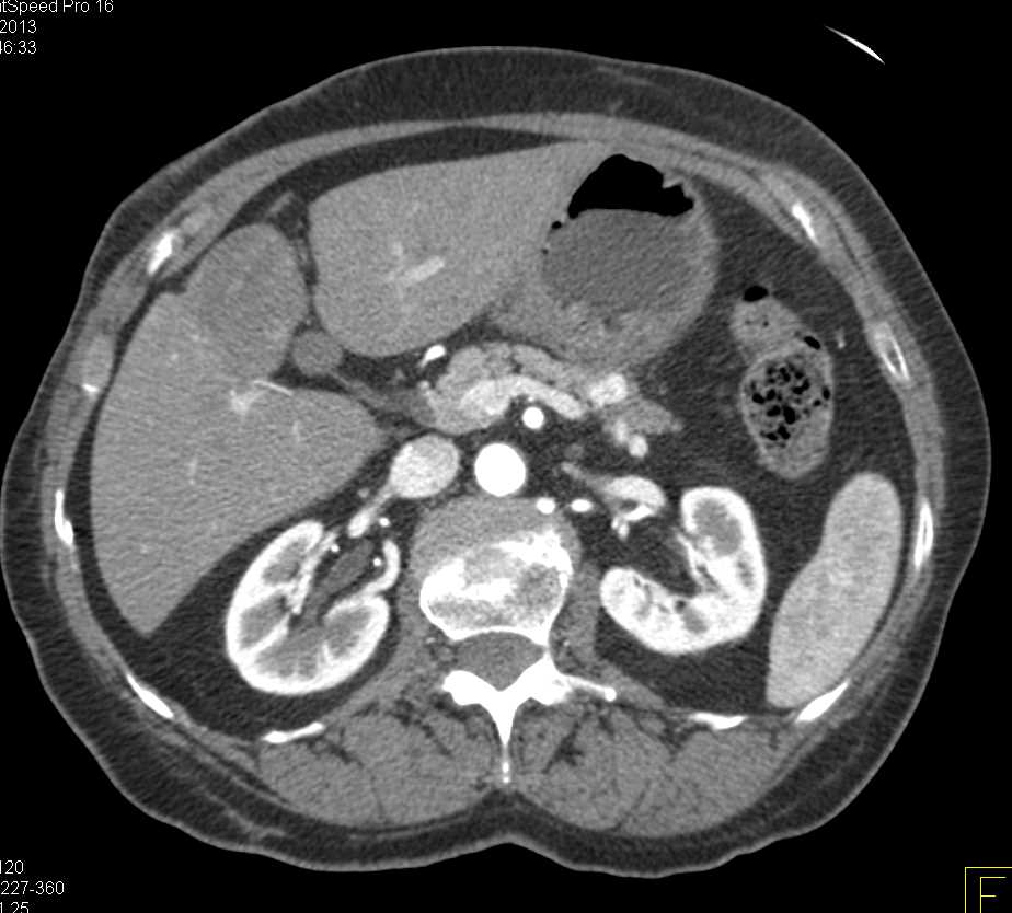 1cm Neuroendocrine Tumor Body of the Pancreas - CTisus CT Scan