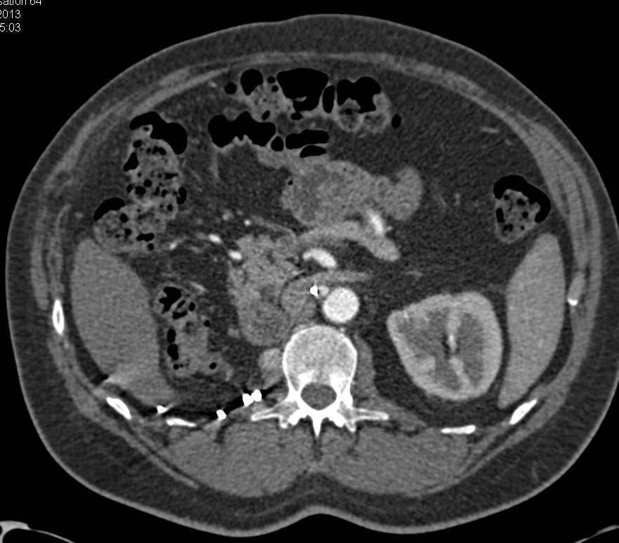 Renal Cell Carcinoma with Metastases to the Pancreas and Right Gluteal Muscle - CTisus CT Scan