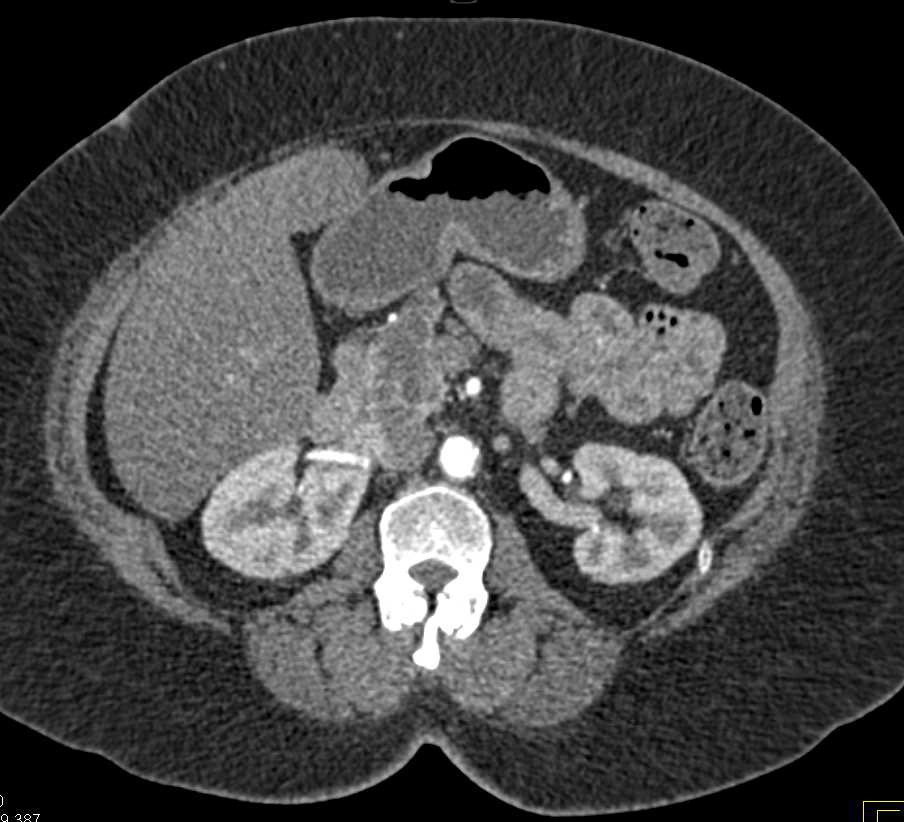 Cystic Lesion in Head of Pancreas due to Intraductal Papillary Mucinous Neoplasm (IPMN) - CTisus CT Scan