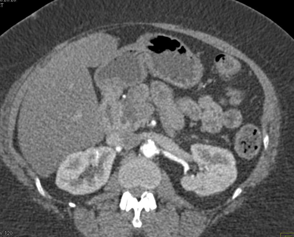 Dilated Pancreatic Duct with Subtle Carcinoma in the Head of the Pancreas - CTisus CT Scan