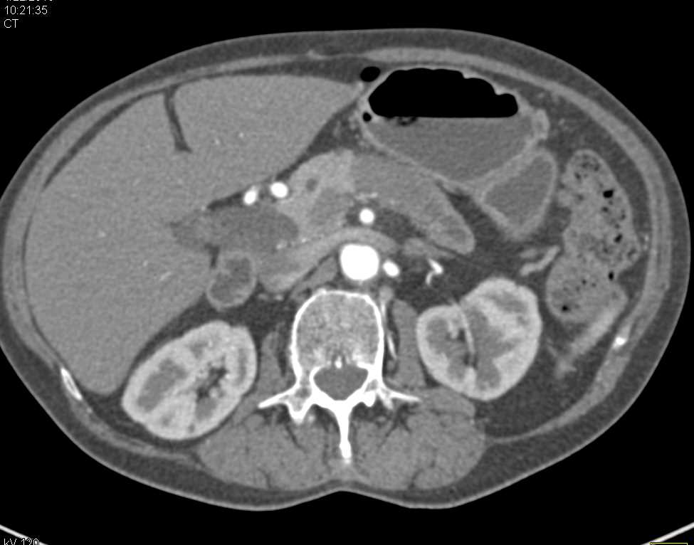 Carcinoma of the Body and Tail of the Pancreas - CTisus CT Scan